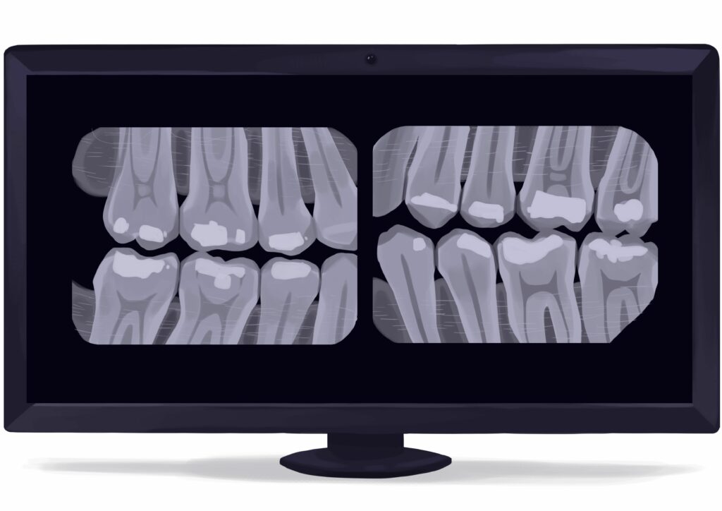 x-rays bitewings radiographs dental