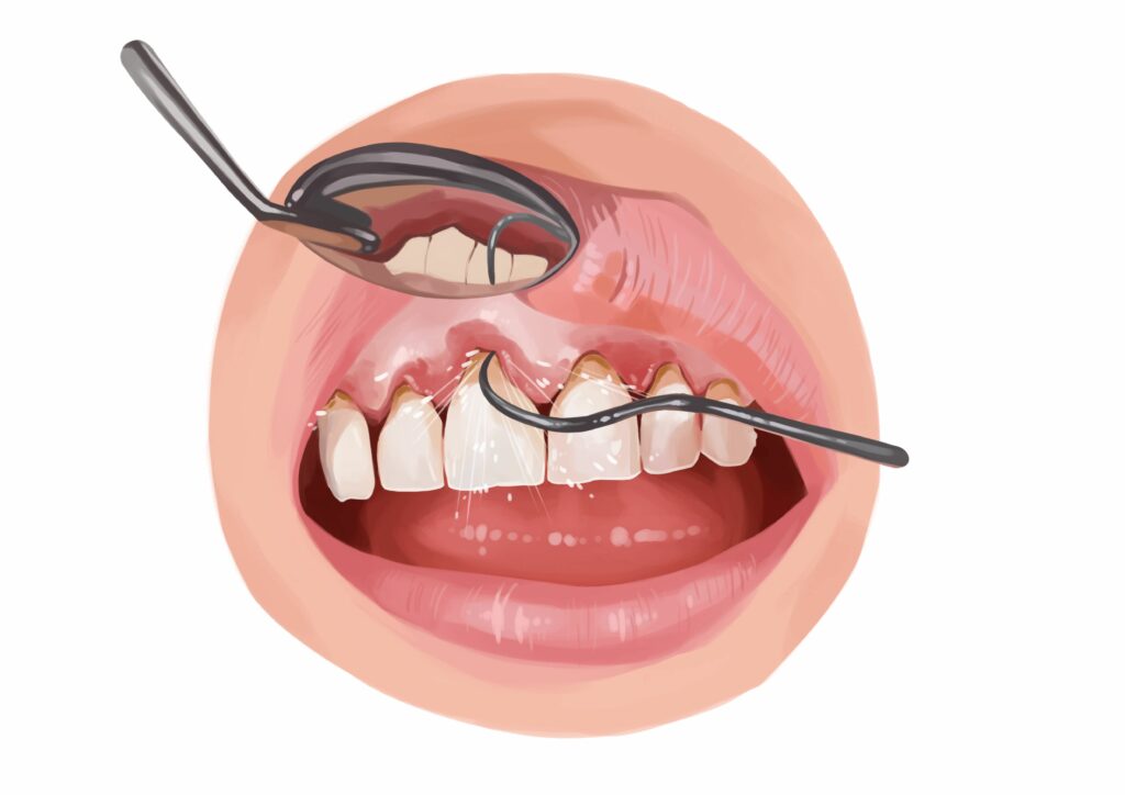 periodontitis gingivitis periodontal disease scaling root planing deep cleaning