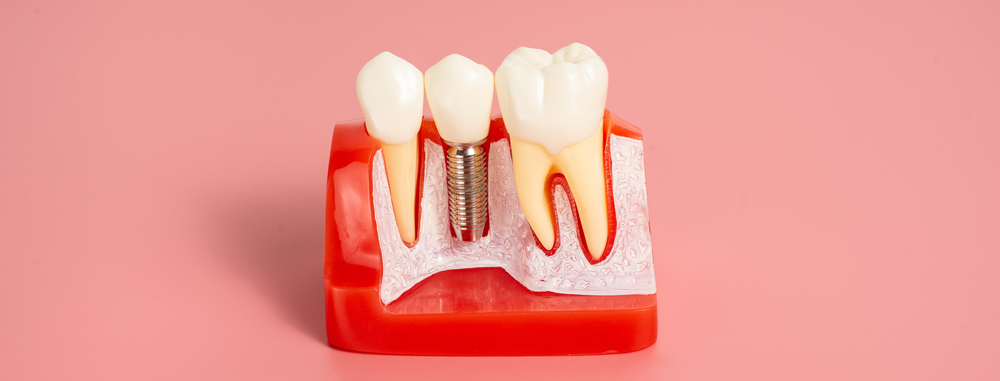 dental implants fresno